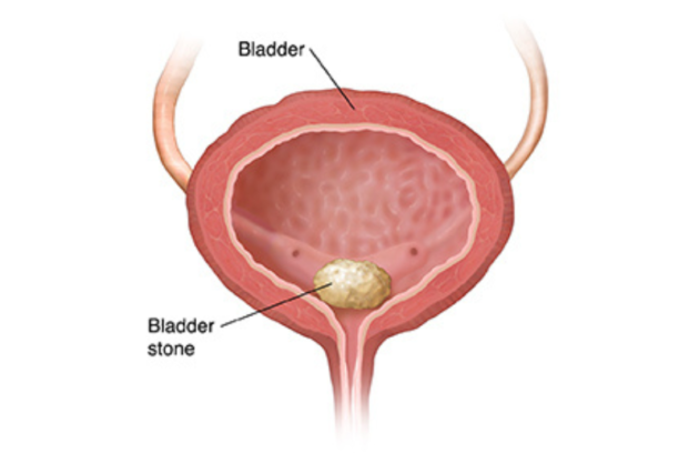 Cystolitholapaxy Bladder Stone Surgery