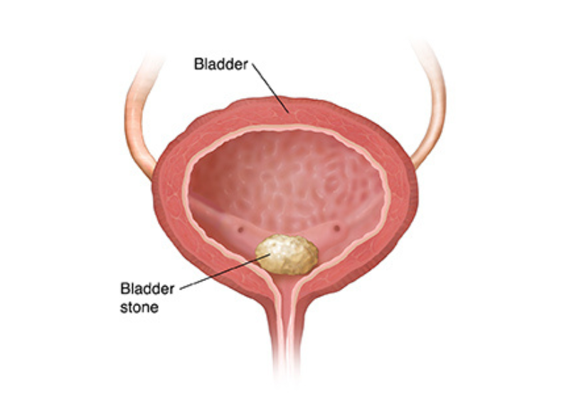 Cystolitholapaxy Bladder Stone Surgery