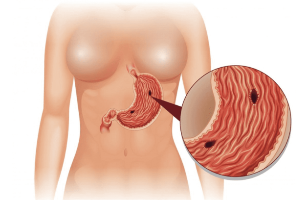 Intestinal perforation (Gastric & Enteric)