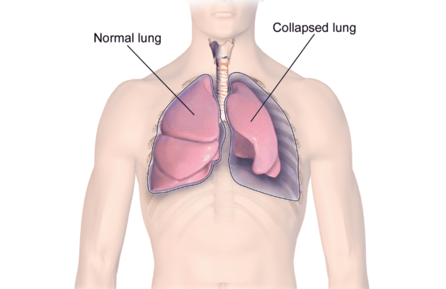 Pneumothorax ( ICD )